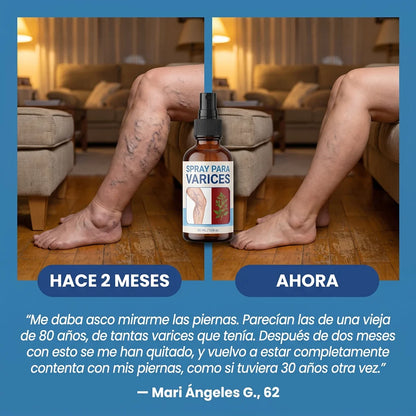 Spray de Crioterapia para Eliminar la Aparición de Varices y Arañitas